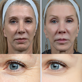 NOVO FaceLift™ 2.0 Redutor de Gordura Facial  4 em 1 + Ebook Exclusivo de Brinde com 57 RECEITAS PARA EMAGRECER 30kg em 30 Dias