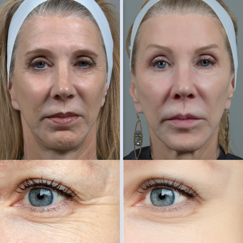 NOVO FaceLift™ 2.0 Redutor de Gordura Facial  4 em 1 + Ebook Exclusivo de Brinde com 57 RECEITAS PARA EMAGRECER 30kg em 30 Dias